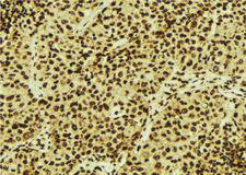 CARF / ALS2CR8 Antibody - 1:100 staining human breast carcinoma tissue by IHC-P. The sample was formaldehyde fixed and a heat mediated antigen retrieval step in citrate buffer was performed. The sample was then blocked and incubated with the antibody for 1.5 hours at 22°C. An HRP conjugated goat anti-rabbit antibody was used as the secondary.