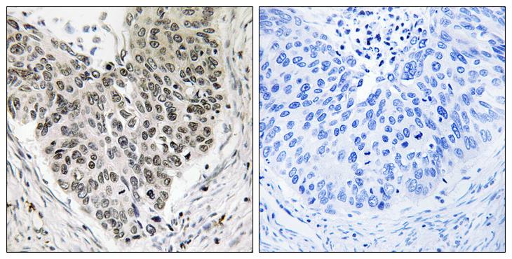 CARF / ALS2CR8 Antibody - Peptide - + Immunohistochemistry analysis of paraffin-embedded human lung carcinoma tissue, using ALS2CR8 antibody.