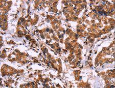 CARMA1 / CARD11 Antibody - Immunohistochemistry of paraffin-embedded Human liver cancer using CARD11 Polyclonal Antibody at dilution of 1:40.
