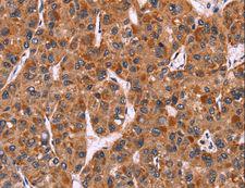 CARMA1 / CARD11 Antibody - Immunohistochemistry of paraffin-embedded Human colon cancer using CARD11 Polyclonal Antibody at dilution of 1:40.