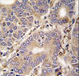 CARS2 Antibody - Formalin-fixed and paraffin-embedded human hepatocarcinoma tissue reacted with CARS2 antibody , which was peroxidase-conjugated to the secondary antibody, followed by DAB staining. This data demonstrates the use of this antibody for immunohistochemistry; clinical relevance has not been evaluated.