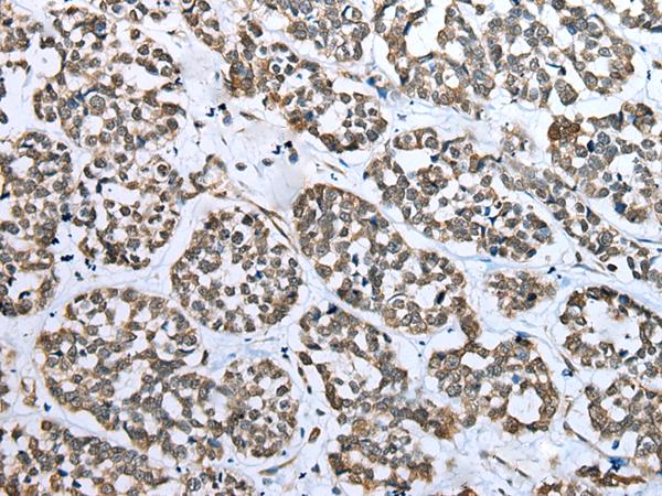 CARTPT / CART Antibody - Immunohistochemistry of paraffin-embedded Human esophagus cancer tissue  using CARTPT Polyclonal Antibody at dilution of 1:25(×200)