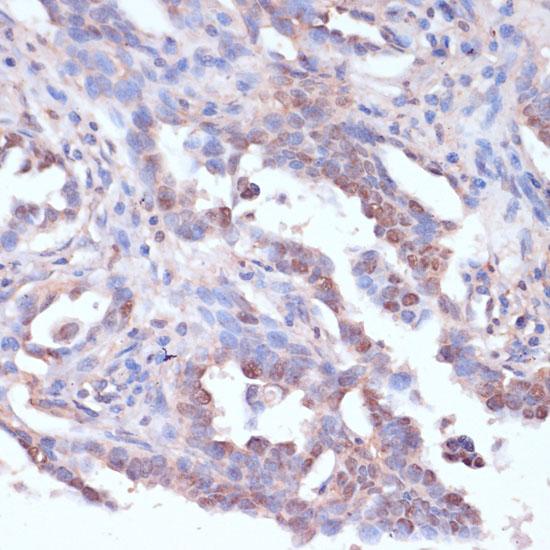 CARTPT / CART Antibody - Immunohistochemistry of paraffin-embedded Human lung cancer using CARTPT Polyclonal Antibody at dilution of 1:100 (40x lens).