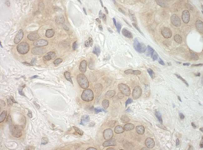 CASC3 / MLN51 Antibody - Detection of Human CASC3 by Immunohistochemistry. Sample: FFPE section of human breast carcinoma. Antibody: Affinity purified rabbit anti-CASC3 used at a dilution of 1:250.