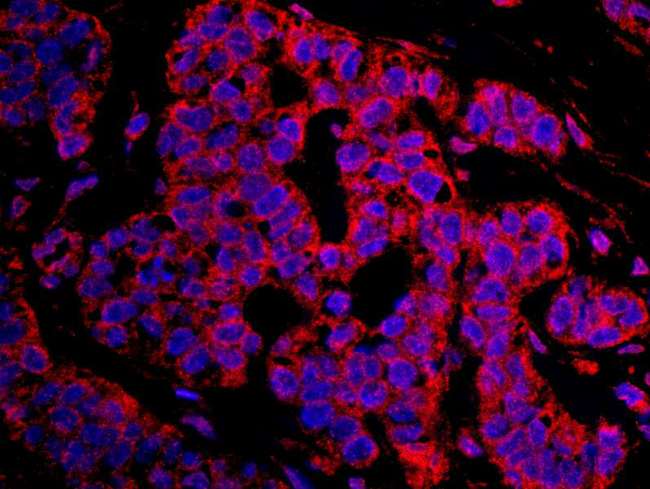 CASC3 / MLN51 Antibody - Detection of Human CASC3 by Immunohistochemistry. Sample: FFPE section of human breast carcinoma. Antibody: Affinity purified rabbit anti-CASC3 used at a dilution of 1:100. Detection:Red-fluorescent Goat anti-Rabbit IgG-heavy and light chain cross-adsorbed Antibody DyLight 594 Conjugated (A120-601D4) used at a dilution of 1:100.