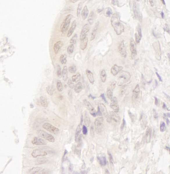 CASC5 Antibody - Detection of Human CASC5 by Immunohistochemistry. Sample: FFPE section of human lung carcinoma. Antibody: Affinity purified rabbit anti-CASC5 used at a dilution of 1:250. Epitope Retrieval Buffer-High pH (IHC-101J) was substituted for Epitope Retrieval Buffer-Reduced pH.