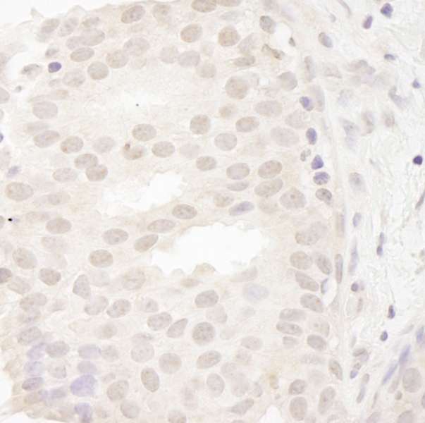 CASC5 Antibody - Detection of Human CASC5 by Immunohistochemistry. Sample: FFPE section of human breast carcinoma. Antibody: Affinity purified rabbit anti-CASC5 used at a dilution of 1:250. Epitope Retrieval Buffer-High pH (IHC-101J) was substituted for Epitope Retrieval Buffer-Reduced pH.