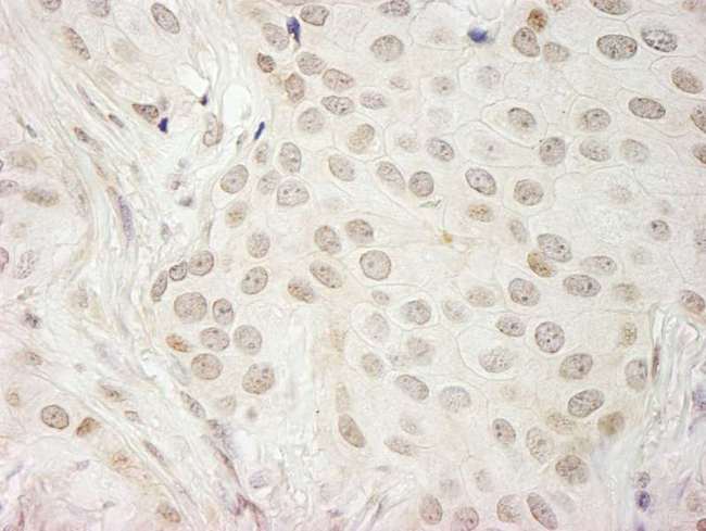 CASC5 Antibody - Detection of Human CASC5 by Immunohistochemistry. Sample: FFPE section of human breast carcinoma. Antibody: Affinity purified rabbit anti-CASC5 used at a dilution of 1:1000 (1 ug/ml).