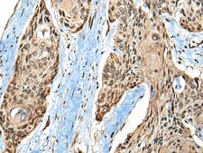 CASK Antibody - Immunohistochemistry of paraffin-embedded Human esophagus cancer tissue  using CASK Polyclonal Antibody at dilution of 1:65(×200)