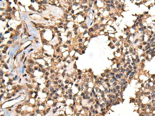 CASK Antibody - Immunohistochemistry of paraffin-embedded Human ovarian cancer tissue  using CASK Polyclonal Antibody at dilution of 1:65(×200)