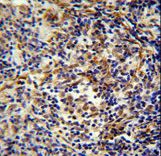 CASKIN2 Antibody - CASKIN2 antibody immunohistochemistry of formalin-fixed and paraffin-embedded human lung carcinoma followed by peroxidase-conjugated secondary antibody and DAB staining.