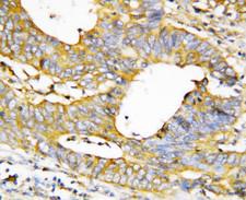 CASP1 / Caspase 1 Antibody - CASP1 / Caspase 1 antibody. IHC(P): Human Breast Cancer Tissue.