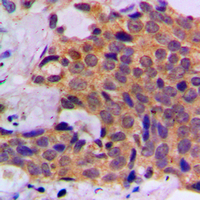 CASP1 / Caspase 1 Antibody - Immunohistochemical analysis of Caspase 1 staining in human breast cancer formalin fixed paraffin embedded tissue section. The section was pre-treated using heat mediated antigen retrieval with sodium citrate buffer (pH 6.0). The section was then incubated with the antibody at room temperature and detected using an HRP conjugated compact polymer system. DAB was used as the chromogen. The section was then counterstained with hematoxylin and mounted with DPX.