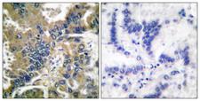 CASP1 / Caspase 1 Antibody - Cl-peptide - + Immunohistochemical analysis of paraffin-embedded human lung carcinoma tissue using Caspase 1 (Cleaved-Asp210) antibody.