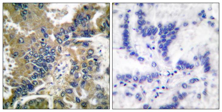 CASP1 / Caspase 1 Antibody - Cl-peptide - + Immunohistochemical analysis of paraffin-embedded human lung carcinoma tissue using Caspase 1 (Cleaved-Asp210) antibody.