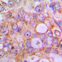 CASP1 / Caspase 1 Antibody - Immunohistochemical analysis of Caspase 1 staining in human lung cancer formalin fixed paraffin embedded tissue section. The section was pre-treated using heat mediated antigen retrieval with sodium citrate buffer (pH 6.0). The section was then incubated with the antibody at room temperature and detected using an HRP conjugated compact polymer system. DAB was used as the chromogen. The section was then counterstained with hematoxylin and mounted with DPX.
