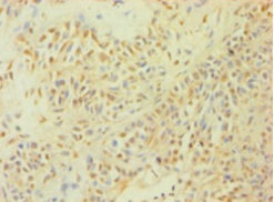 CASP1 / Caspase 1 Antibody - Immunohistochemistry of paraffin-embedded human breast cancer using CASP1 Antibody at dilution of 1:100