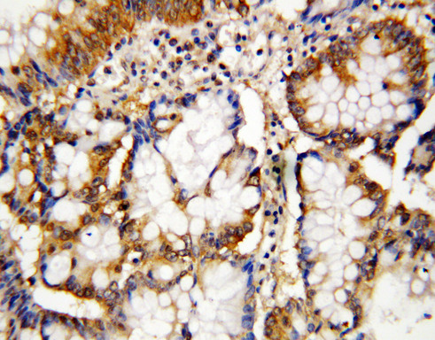 CASP10 / Caspase 10 Antibody - CASP10 / Caspase 10 antibody. IHC(P): Human Intestinal Cancer Tissue.