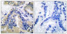 CASP10 / Caspase 10 Antibody - Immunohistochemistry analysis of paraffin-embedded human lung carcinoma tissue, using Caspase 10 Antibody. The picture on the right is blocked with the synthesized peptide.