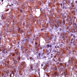 CASP10 / Caspase 10 Antibody - Human liver ca. stained with anti-Caspase 10