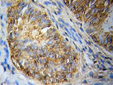 CASP10 / Caspase 10 Antibody - Immunohistochemistry (IHC) analysis of CASP10 pAb in paraffin-embedded Endometrial cancer tissue.
