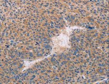 CASP10 / Caspase 10 Antibody - Immunohistochemistry of paraffin-embedded Human lung cancer using CASP10 Polyclonal Antibody at dilution of 1:30.