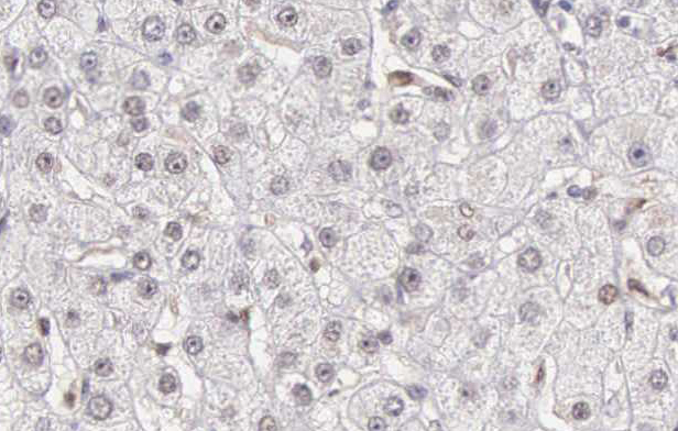 CASP10 / Caspase 10 Antibody - 1:200 staining human liver carcinoma tissues by IHC-P. The tissue was formaldehyde fixed and a heat mediated antigen retrieval step in citrate buffer was performed. The tissue was then blocked and incubated with the antibody for 1.5 hours at 22°C. An HRP conjugated goat anti-rabbit antibody was used as the secondary.