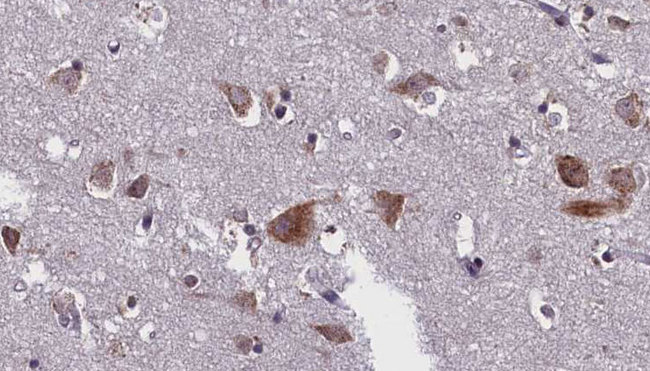 CASP10 / Caspase 10 Antibody - 1:100 staining human brain carcinoma tissue by IHC-P. The sample was formaldehyde fixed and a heat mediated antigen retrieval step in citrate buffer was performed. The sample was then blocked and incubated with the antibody for 1.5 hours at 22°C. An HRP conjugated goat anti-rabbit antibody was used as the secondary.
