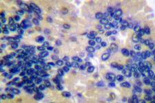 CASP10 / Caspase 10 Antibody - IHC of Caspase 10 (K442)pAb in paraffin-embedded human lung carcinoma tissue.