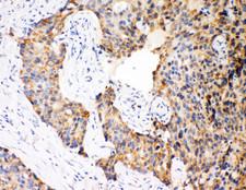 CASP12 / Caspase 12 Antibody - CASP12 / Caspase 12 antibody. IHC(P): Human Breast Cancer Tissue.