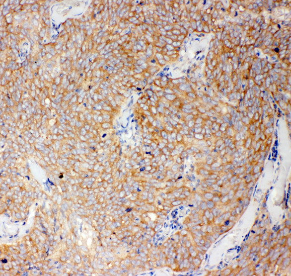 CASP12 / Caspase 12 Antibody - CASP12 / Caspase 12 antibody. IHC(P): Human Lung Cancer Tissue.