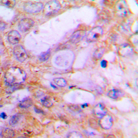 CASP12 / Caspase 12 Antibody - Immunohistochemical analysis of Caspase 12 staining in human lung cancer formalin fixed paraffin embedded tissue section. The section was pre-treated using heat mediated antigen retrieval with sodium citrate buffer (pH 6.0). The section was then incubated with the antibody at room temperature and detected using an HRP conjugated compact polymer system. DAB was used as the chromogen. The section was then counterstained with hematoxylin and mounted with DPX.