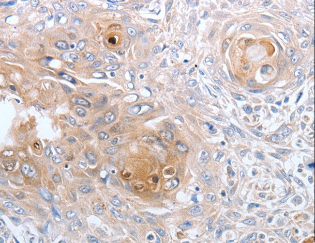 CASP12 / Caspase 12 Antibody - Immunohistochemistry of paraffin-embedded Human esophagus cancer using CASP12 Polyclonal Antibody at dilution of 1:50.