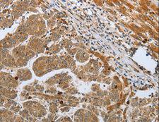 CASP12 / Caspase 12 Antibody - Immunohistochemistry of paraffin-embedded Human liver cancer using CASP12 Polyclonal Antibody at dilution of 1:50.