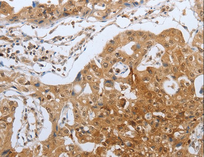 CASP12 / Caspase 12 Antibody - Immunohistochemistry of paraffin-embedded Human lung cancer using CASP12 Polyclonal Antibody at dilution of 1:50.