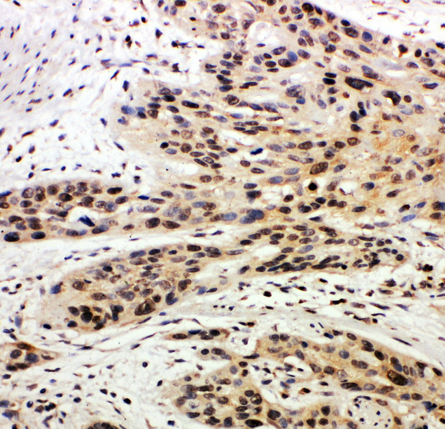 CASP14 / Caspase 14 Antibody - CASP14 / Caspase 14 antibody. IHC(P): Human Esophagus Squama Cancer Tissue.