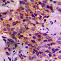 CASP2 / Caspase 2 Antibody - Immunohistochemical analysis of Caspase 2 staining in human breast cancer formalin fixed paraffin embedded tissue section. The section was pre-treated using heat mediated antigen retrieval with sodium citrate buffer (pH 6.0). The section was then incubated with the antibody at room temperature and detected using an HRP conjugated compact polymer system. DAB was used as the chromogen. The section was then counterstained with hematoxylin and mounted with DPX. w