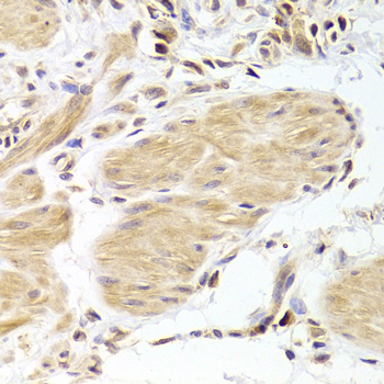 CASP2 / Caspase 2 Antibody - Immunohistochemistry of paraffin-embedded Human gastric cancer tissue.