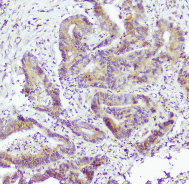 CASP2 / Caspase 2 Antibody - IHC analysis of Caspase-2 using anti-Caspase-2 antibody. Caspase-2 was detected in paraffin-embedded section of human colon cancer tissue. Heat mediated antigen retrieval was performed in citrate buffer (pH6, epitope retrieval solution) for 20 mins. The tissue section was blocked with 10% goat serum. The tissue section was then incubated with 1µg/ml rabbit anti-Caspase-2 Antibody overnight at 4°C. Biotinylated goat anti-rabbit IgG was used as secondary antibody and incubated for 30 minutes at 37°C. The tissue section was developed using Strepavidin-Biotin-Complex (SABC) with DAB as the chromogen.