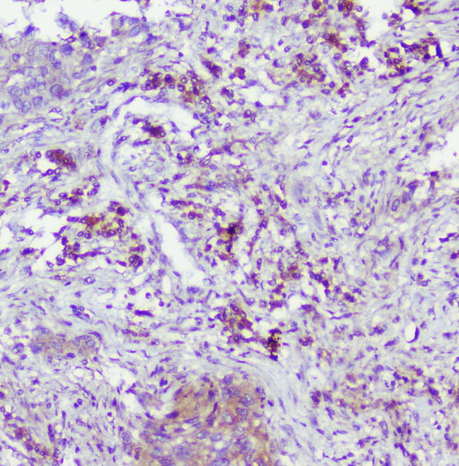 CASP2 / Caspase 2 Antibody - IHC analysis of Caspase-2 using anti-Caspase-2 antibody. Caspase-2 was detected in paraffin-embedded section of human lung cancer tissue. Heat mediated antigen retrieval was performed in citrate buffer (pH6, epitope retrieval solution) for 20 mins. The tissue section was blocked with 10% goat serum. The tissue section was then incubated with 1µg/ml rabbit anti-Caspase-2 Antibody overnight at 4°C. Biotinylated goat anti-rabbit IgG was used as secondary antibody and incubated for 30 minutes at 37°C. The tissue section was developed using Strepavidin-Biotin-Complex (SABC) with DAB as the chromogen.