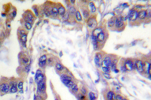 CASP2 / Caspase 2 Antibody - IHC of Caspase 2 (K136) pAb in paraffin-embedded human lung carcinoma tissue.
