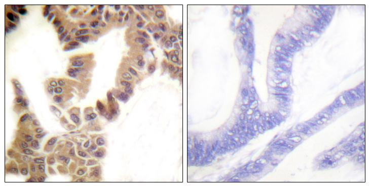 CASP2 / Caspase 2 Antibody - Immunohistochemistry analysis of paraffin-embedded human lung carcinoma, using Caspase 2 (Phospho-Ser157) Antibody. The picture on the right is blocked with the phospho peptide.