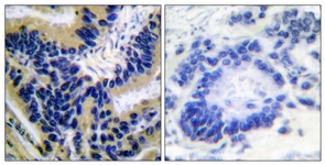 CASP3 / Caspase 3 Antibody - IHC of paraffin-embedded human lung carcinoma, using Caspase 3 (Cleaved-Asp175) Antibody. The picture on the right is treated with the synthesized peptide.