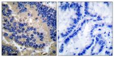 CASP3 / Caspase 3 Antibody - IHC of paraffin-embedded human lung carcinoma tissue, using Caspase 3 (Cleaved-Asp175) Antibody. The picture on the right is treated with the synthesized peptide.