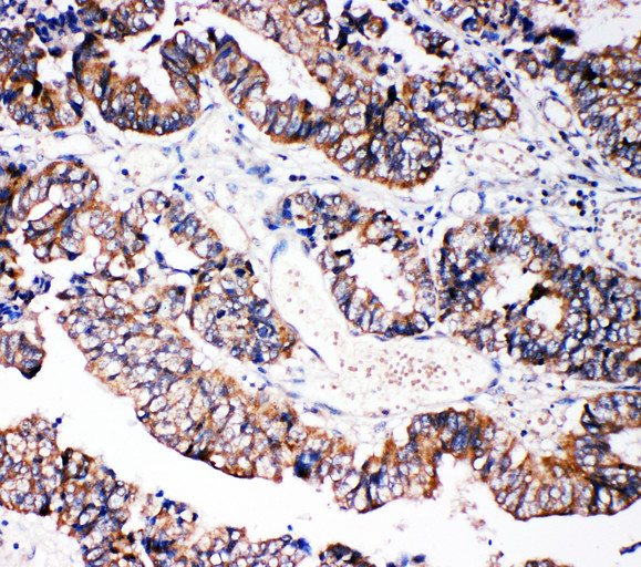 CASP3 / Caspase 3 Antibody - CASP3 / Caspase 3 antibody. IHC(P): Human Intestinal Cancer Tissue.