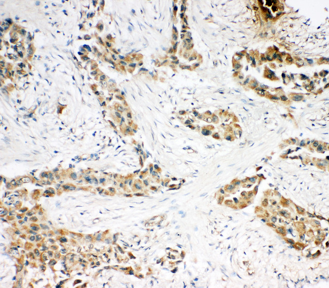 CASP3 / Caspase 3 Antibody - CASP3 / Caspase 3 antibody. IHC(P): Human Lung Cancer Tissue.