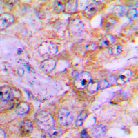 CASP3 / Caspase 3 Antibody - Immunohistochemical analysis of Caspase 3 staining in human lung cancer formalin fixed paraffin embedded tissue section. The section was pre-treated using heat mediated antigen retrieval with sodium citrate buffer (pH 6.0). The section was then incubated with the antibody at room temperature and detected using an HRP conjugated compact polymer system. DAB was used as the chromogen. The section was then counterstained with hematoxylin and mounted with DPX.
