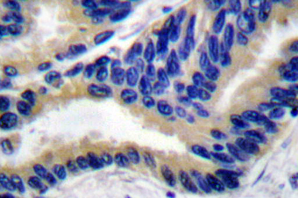CASP3 / Caspase 3 Antibody - IHC of Activated-Caspase-3 p17 pAb in paraffin-embedded human lung carcinoma tissue.