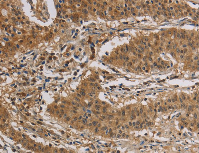 CASP3 / Caspase 3 Antibody - Immunohistochemistry of paraffin-embedded Human gastric cancer using CASP3 Polyclonal Antibody at dilution of 1:30.