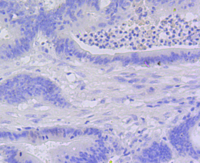 CASP3 / Caspase 3 Antibody - Immunohistochemistry of paraffin-embedded human colon carcinoma using CASP3 antibodyat dilution of 1:100 (40x lens).
